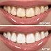 Natural Activated Charcoal Teeth Whitening Kit Special for Sensitive Teeth