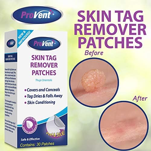 skin tag removal cost
