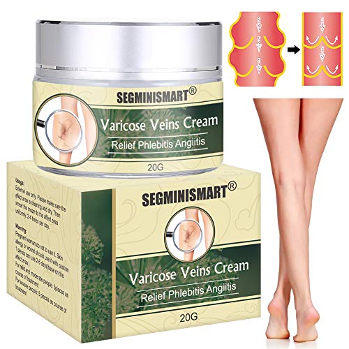 varicose veins vein treatment cream spider legs relief pulled shelves been phlebitis blood