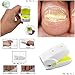 Tiehnom Nail Cleaning Laser Device, Safe, Quick, Painless Nail Fungus Laser Treatment For Toe and Finger Nails, No Side Effects