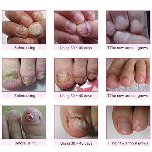 Nail Treatment,Repair Toenails,Nail Repair Solution, Nail Treatment Care for Nails and Cuticles - Thumbnail 5
