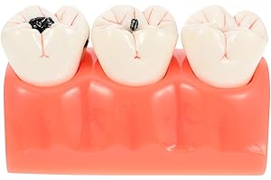 GANAZONO Resin Teeth Model for Teaching Demonstration with Tooth Decay Anatomy, Practical 4X Enlarged Model