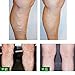 Ochine Varicose Veins Ointment Vasculitis Treatment Phlebitis Angiitis Inflammation Blood vessel Rotten legs Cream