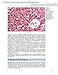 Scheuer's Liver Biopsy Interpretation