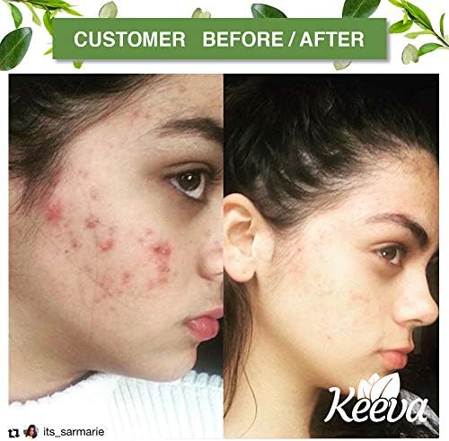 tea tree oil spot treatment