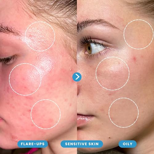 Hypochlorous Acid Spray – Dermatologist Tested HOCl Facial Cleanser for Sensitive, Acne-Prone & Irritated Skin – Soothes Redness, Eczema, Rashes & Itching – Skin Repair Spray, 60 ml + 200 ml - Honeydew Labs