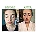 7X FASTER Acne Treatment for Scars, Cystic Spots & Blackheads Secret TEA TREE OIL + Salicylic Acid Dermatologist Recommended for Fast Scar Removal - Get Rid of Bacne in Days (1 oz)