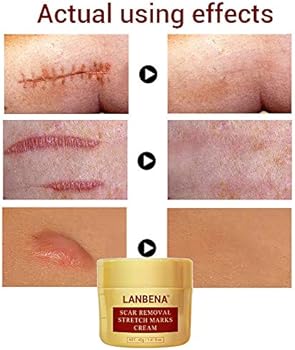 lanbena stretch mark removal