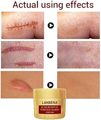 lanbena scar removal stretch marks cream