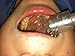 Kona Adapter 2.0 Kit - Attach **Isolite** Dental Mouthpieces Directly to your HVE valve