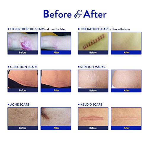 Aroamas Professional Silicone C-Section Scar Removal Sheets, Soft Adhesive Fabric Strips, Drug-Free, Relieves Itching, Remove Keloid Scars, Acne (2 Month Supply)