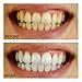 Teeth Whitening Kit - 30 Treatments Whitening Gel Kit + 20 Remineralization Gel + 3 Vitamin E Swabs + UV Light