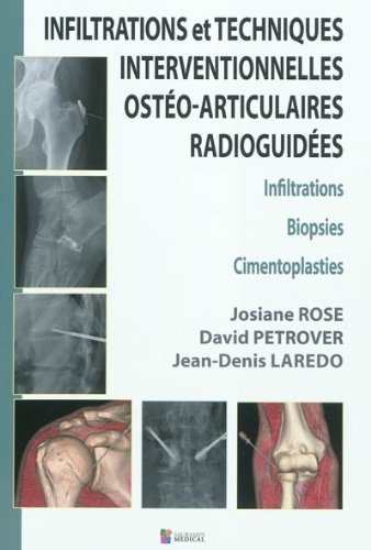 Infiltrations Et Techniques Interventionnelles Osteo-articulaires Radioguidees