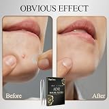 Sugelary 252 Pcs Pimple Patches Hydrocolloid Waterproof Invisible Spot Treatment view 2