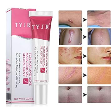 cream for acne scars and pigmentation