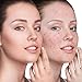 Acne Treatment, Acne Removal, Pimple Cream, Advanced Anti Acne Cream, Remove Acne, Repair Acne Natural/Quickly