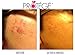 Protege FLAWless Scar Gel Cream, Best for Scar Removal, Flattens and Softens Scars (1 ounce)