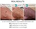 6ft Trim-to-Size Roll - Fade Away Silicone Gel Scar Treatment Sheets - Designed by Plastic Surgeons