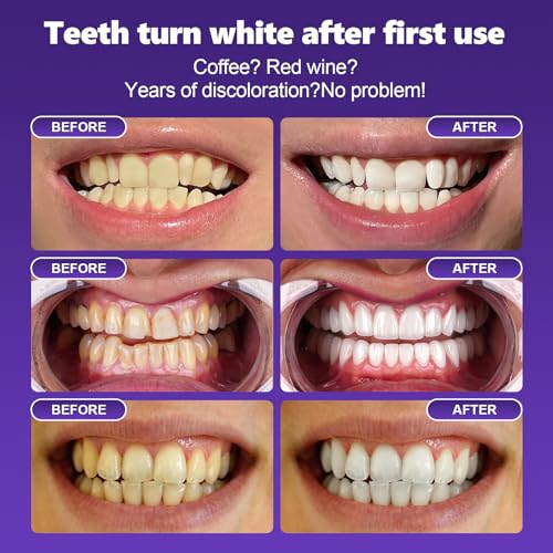 14 pares Tiras blanqueadoras moradas,Tiras blanqueadoras dientes,Blanqueamiento dental rápido,Dientes blanqueador dental,Para dientes para el café vino, tabaco y otras manchas