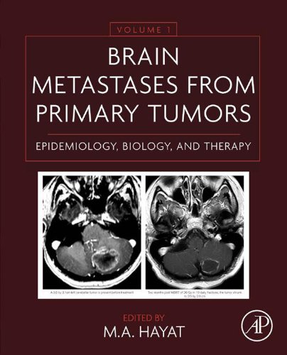 Brain Metastases from Primary Tumors Volume 1: Epidemiology, Biology, and Therapy