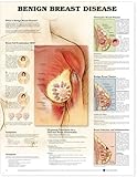 Benign Breast Disease Anatomical Chart, Anatomical Chart Company Staff, 1587796732