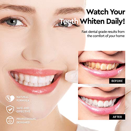Premium Teeth Whitening Kit, LED Light, 35% Carbamide Peroxide, Safe & Natural At-Home System Without Pain or Sensitivity, Effectively Removes Stains for Whiter Teeth