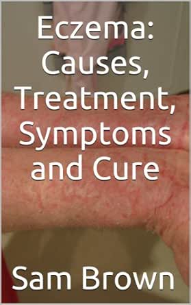 Eczema Causes Treatment Symptoms And Cure Kindle Edition By Brown Sam Health Fitness Dieting Kindle Ebooks Amazon Com