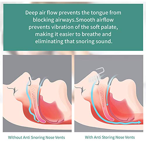 KEEOU Anti Snoring Nose Vents, [8 Pack BPAFree] Reusable & No Side Effect Stop Snoring