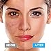 Skin Tag Remover, HOMFUL Spot Eraser Pro for Warts, Age Spots, Tattoo, Nevus, Birthmark, Skin Pigmentation - Portable Safety USB Rechargeable 9 Adjustable Models