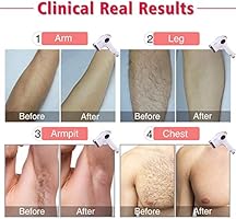 Hwzloik Laser Hair Removal For Women Men 500 000 Flashes Ipl
