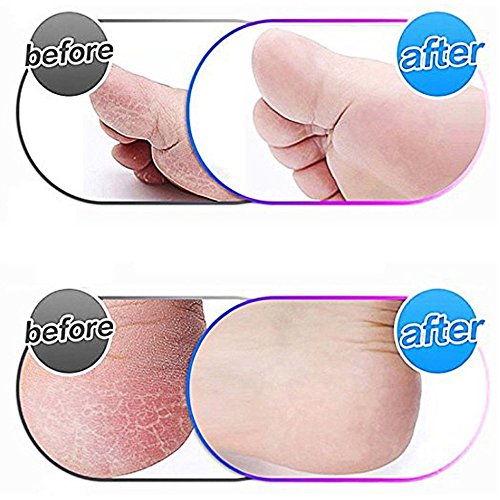The 4 Pack Replacement Roller Refills are specifically designed for use with the Scholl Express Pedi Foot Smoother. The rollers are Extra Coarse, making them perfect for removing hard and tough skin on your feet.