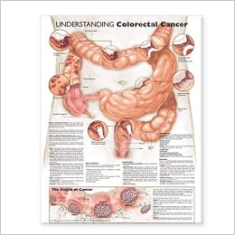 Understanding Colorectal Cancer Anatomical Chart (9780781773348)