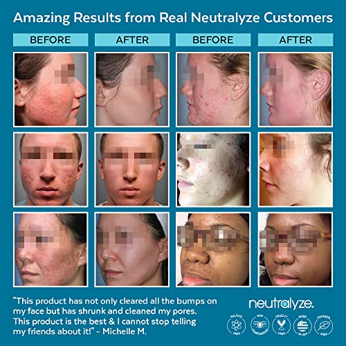 Neutralyze Renewal Complex Acne Moisturizer for Face Time Released