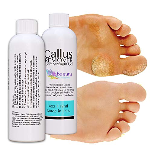 Best Callus Remover.Callus Eliminator,Liquid & Gel For Corn And Callus