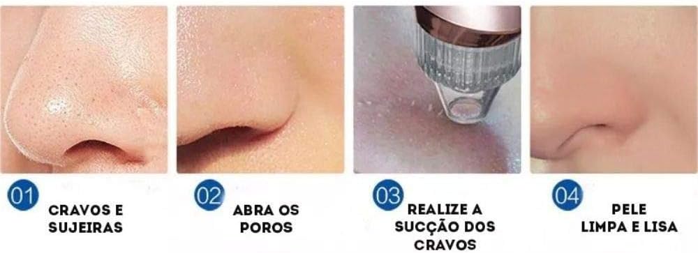 Aparelho Removedor Cravos Vácuo Sucção Acne Brasil Original ...
