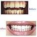 Grinigh Professional Teeth whitening strips - 14 Treatments