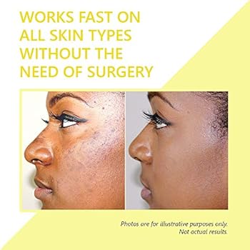 hydroquinone skin lightener & dark spot corrector