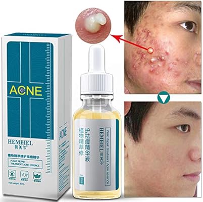 essence acne treatment