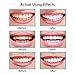 Teeth Whitening Pen, 35% Carbamide Peroxide, 15+ Whitening Treatments, No Sensitivity, 2mL (2 pack)
