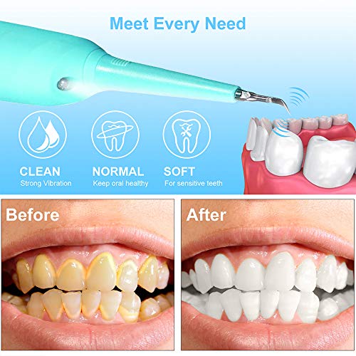 Electric Dental Calculus Remover, SUNVING Tooth Tartar Scraper Dental