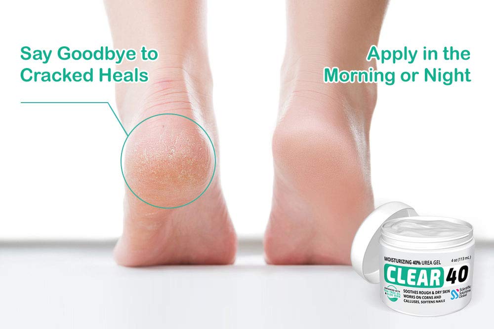 CLEAR 40, 40% Urea Gel, 4 oz w/ Tea Tree & Coconut Oil, Aloe Vera Extract, Callus & Corn Remover Moisturizes & Softens Cracked Heels, Feet, Elbows, Hands, Nails, Re-hydrates skin better than creams : Beauty