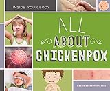 All About Chickenpox