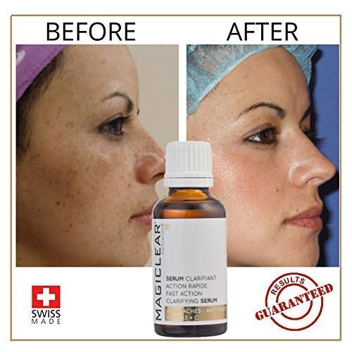 body acne dark spot remover