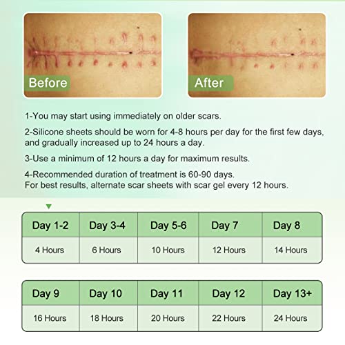 ZODENIS Scar Away Silicone Scar Sheets, Scar Tape(1.8” x 157”Inch- 4M), Scar Strips, Reusable, Professional Scar Remover for C-Section, Surgery, Keloid, Tummy Tuck, Scar Patch, Scar Pads.