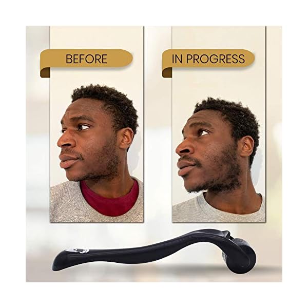 KING-LEONIDAS-05mm-Titanium-Derma-Roller-for-Beard-Growth-Beard-Roller-also-for-Hair-Regrowth-Pigmentation-Fine-Lines-Acne-Scar-Wrinkle-Treatment-Includes-Travel-Case KING LEONIDAS Derma Roller | 540 0.5MM Titanium Needles | Beard Roller for Hair and Beard Growth | Derma Roller Hair…