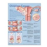 Cover of Understanding Ovarian Cancer Anatomical Chart