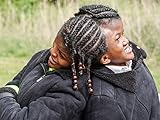 Conjoined Twin Sisters Attached At The Head
