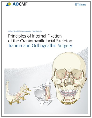 PRINCIPLES OF INTERNAL FIXATION OF THE CRANIOMAXILLOFACIAL SKELETON