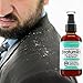 Dry Scalp Treatment, For Psoriasis, Eczema, Itchy And Flaky Scalp - StratumRX Psoriasis Treatment Serum And Itchy Scalp Treatment - Big 4 OZ Size!