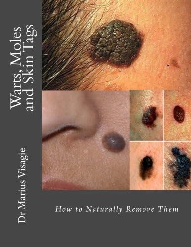 Warts, Moles and Skin Tags: How to Naturally Remove Them